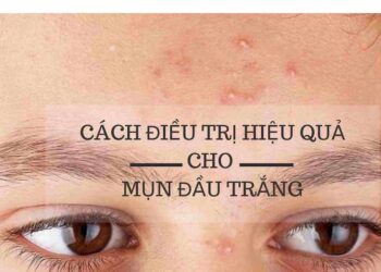 Cách điều trị mụn đầu trắng hiệu quả