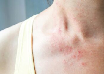 Công dụng của lá chè xanh trong chữa viêm da cơ địa