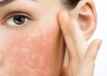 Trị dị ứng da mặt bằng gel nha đam