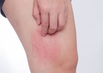 Triệu chứng viêm da dị ứng