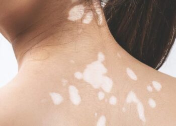 Dấu hiệu của bệnh bạch biến