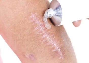 Khám phá công dụng của kem trị sẹo